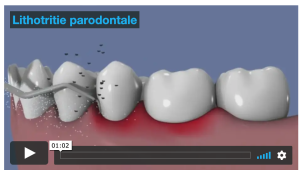 Traitement ultrasonique de la parodontite